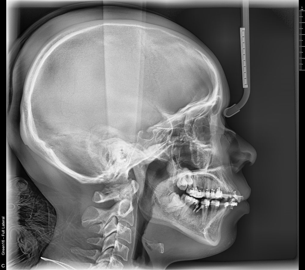Radiographie du crâne de profil