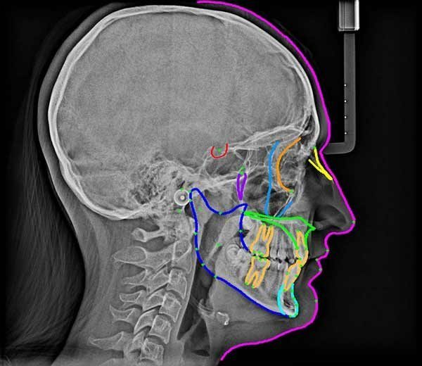 Radiographie de profil avec tracés céphalométriques colorés